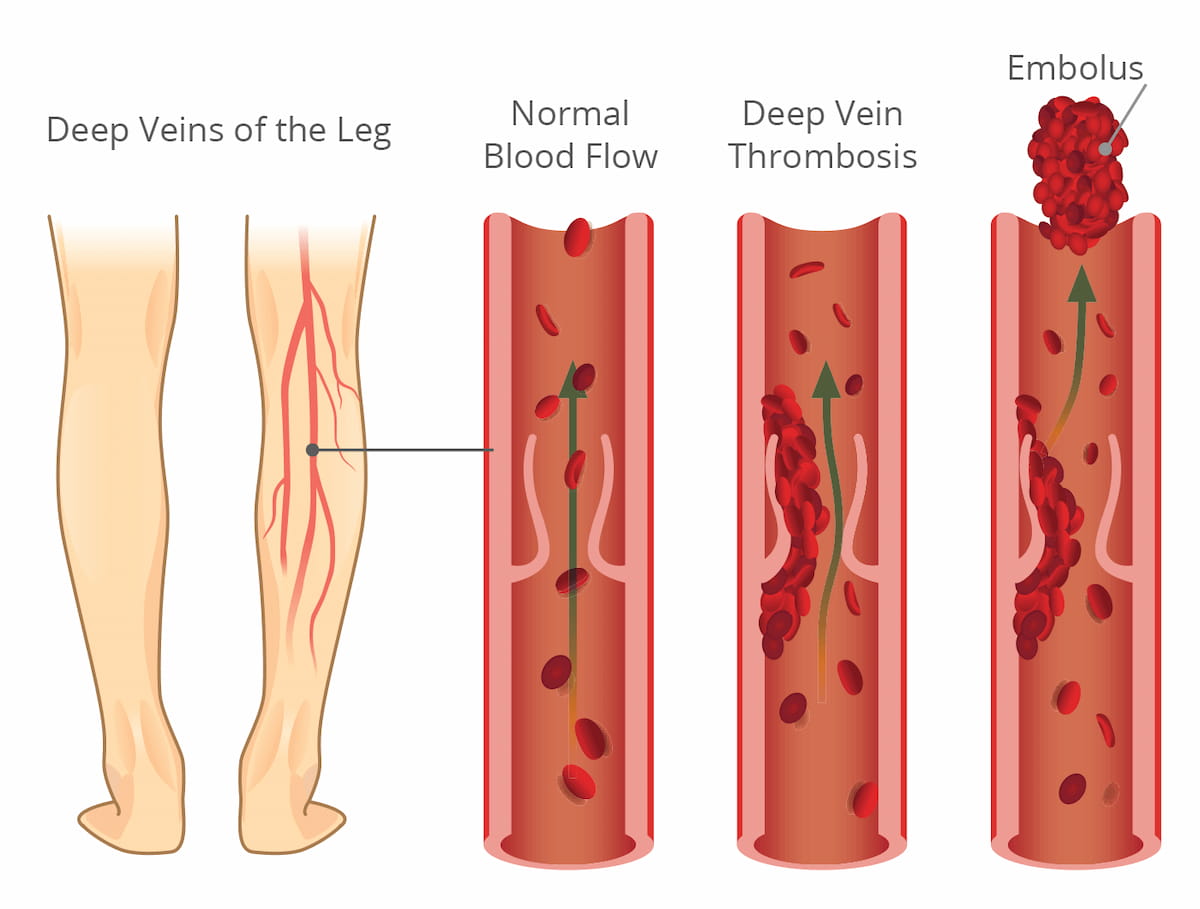 Thrombosis Illustration